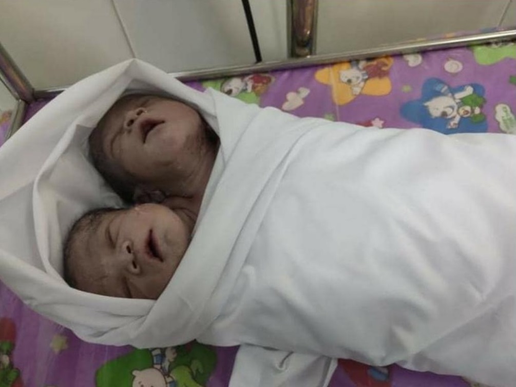 Двухголовый мальчик родился в Мьянме